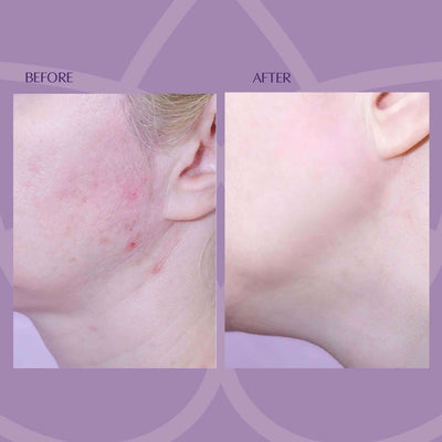 Fruit Acid Peel