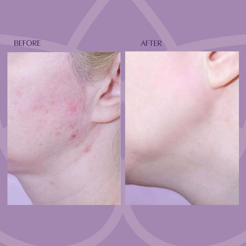Fruit Acid Peel